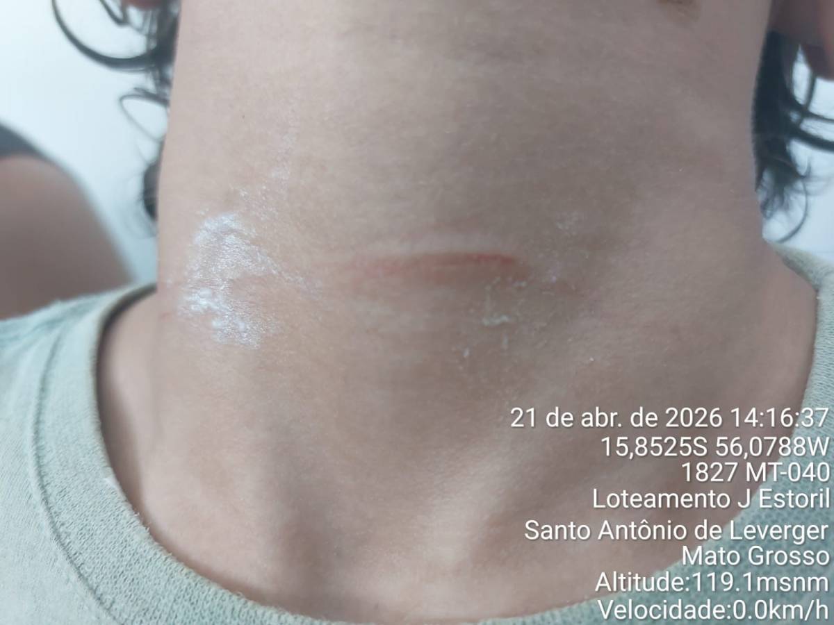 Menino de 7 anos fica ferido após ser atingido por linha de pipa no bairro Fronteira