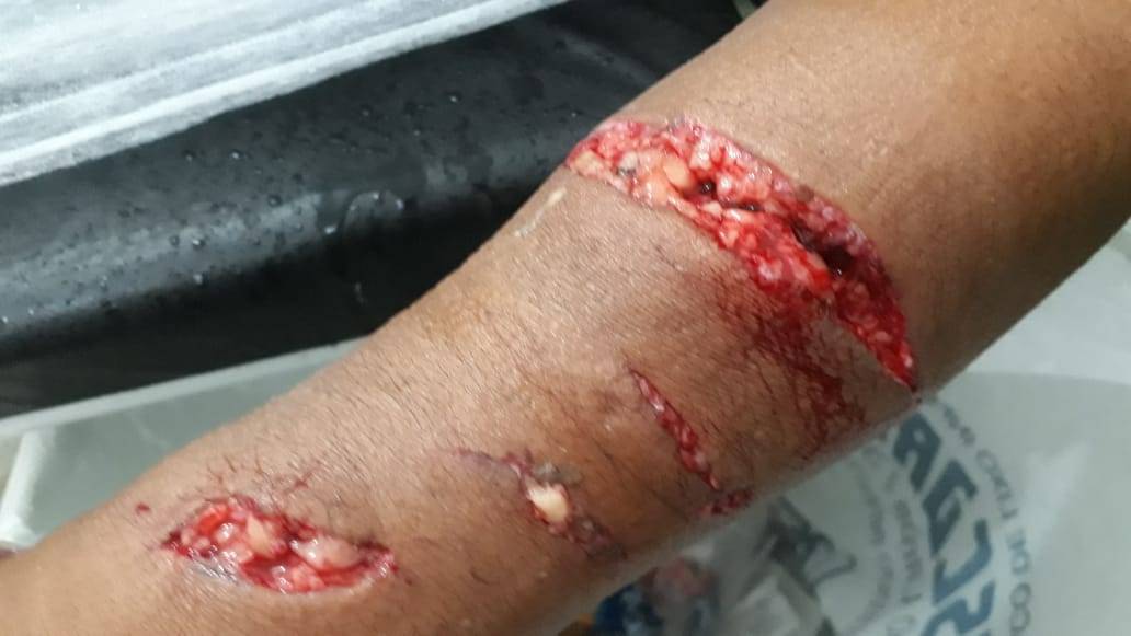 Moradora de Mimoso sofre violento ataque de jacaré 