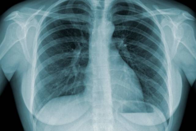 Poconé, Livramento e Chapada estão entre os 36 municípios de MT com alta incidência de Tuberculose, aponta dados da SES