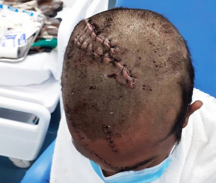 Indígena atacado por onça passa por cirurgia após ter crânio perfurado; veja fotos